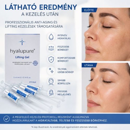 hyalupure® Lifting Gel látható eredmény anti-aging és lifting kezelés után